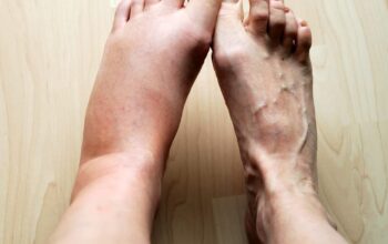 Waspada! Ini 5 Tanda Kaki Bengkak Akibat Masalah Ginjal
