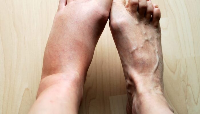 Waspada! Ini 5 Tanda Kaki Bengkak Akibat Masalah Ginjal
