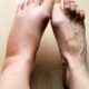 Waspada! Ini 5 Tanda Kaki Bengkak Akibat Masalah Ginjal